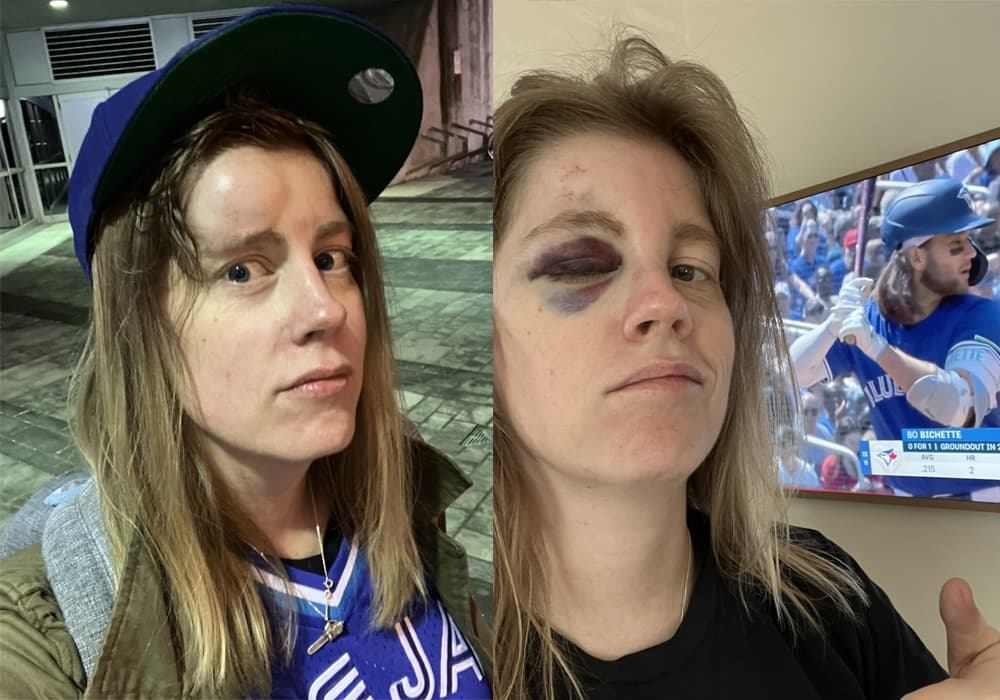 Blue Jays fan Liz McGuire explains her mishap with a foul ball